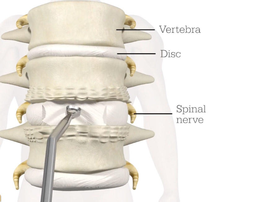 Anterior Lumbar Interbody Fusion (ALIF)