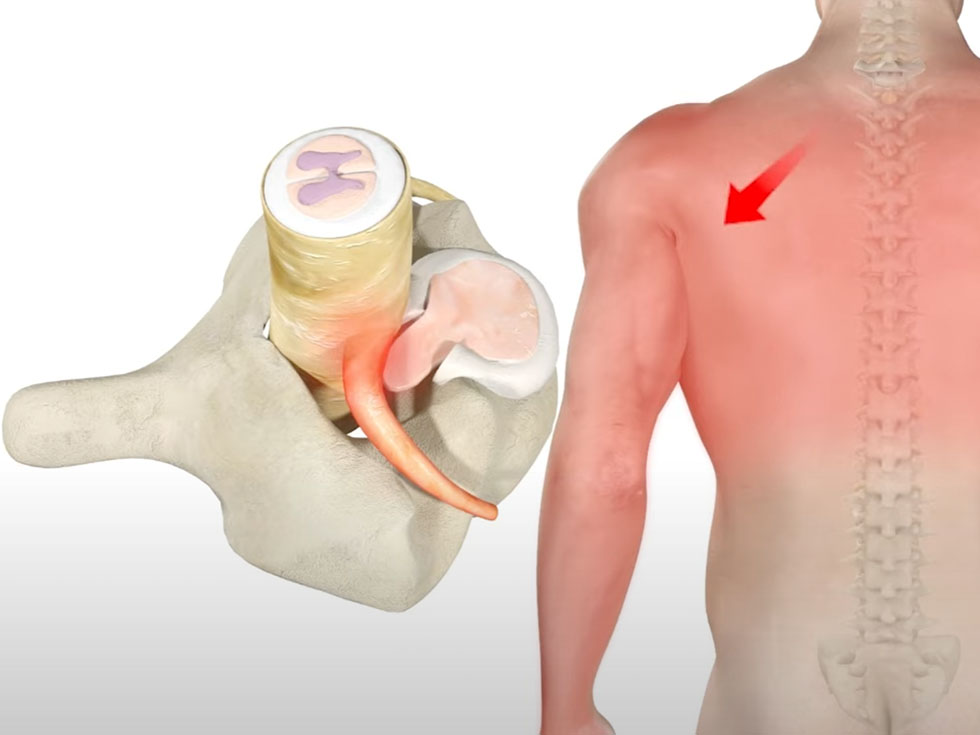 Posterior Neural Foraminotomy